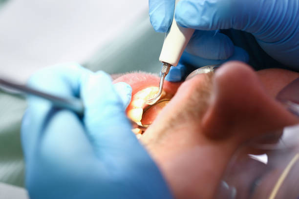 Best Emergency Dental Care for Broken or Chipped Teeth in West Point, MS