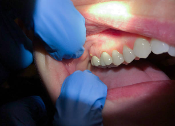 Best Emergency Dental Care for Broken or Chipped Teeth in West Point, MS
